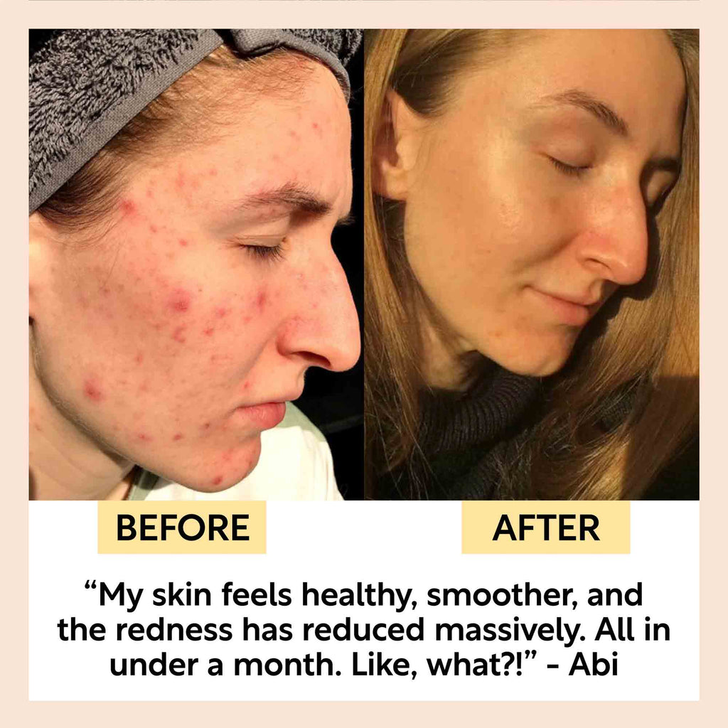 The Acne-Prone Bundle